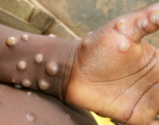 NCDC records 54 new suspected mpox cases in 25 states