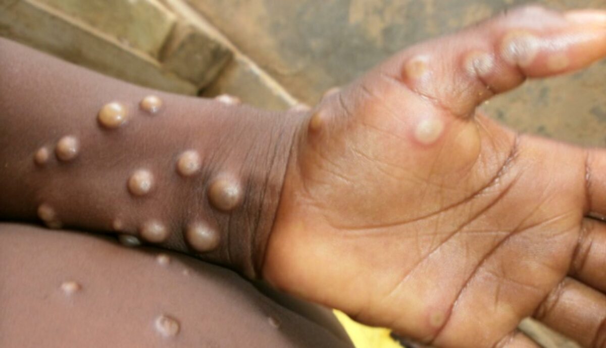 NCDC records 54 new suspected mpox cases in 25 states