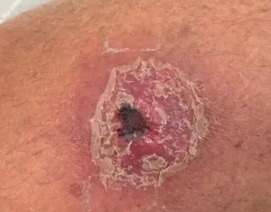 Suspected Buruli Ulcer Kills Eight People in Adamawa