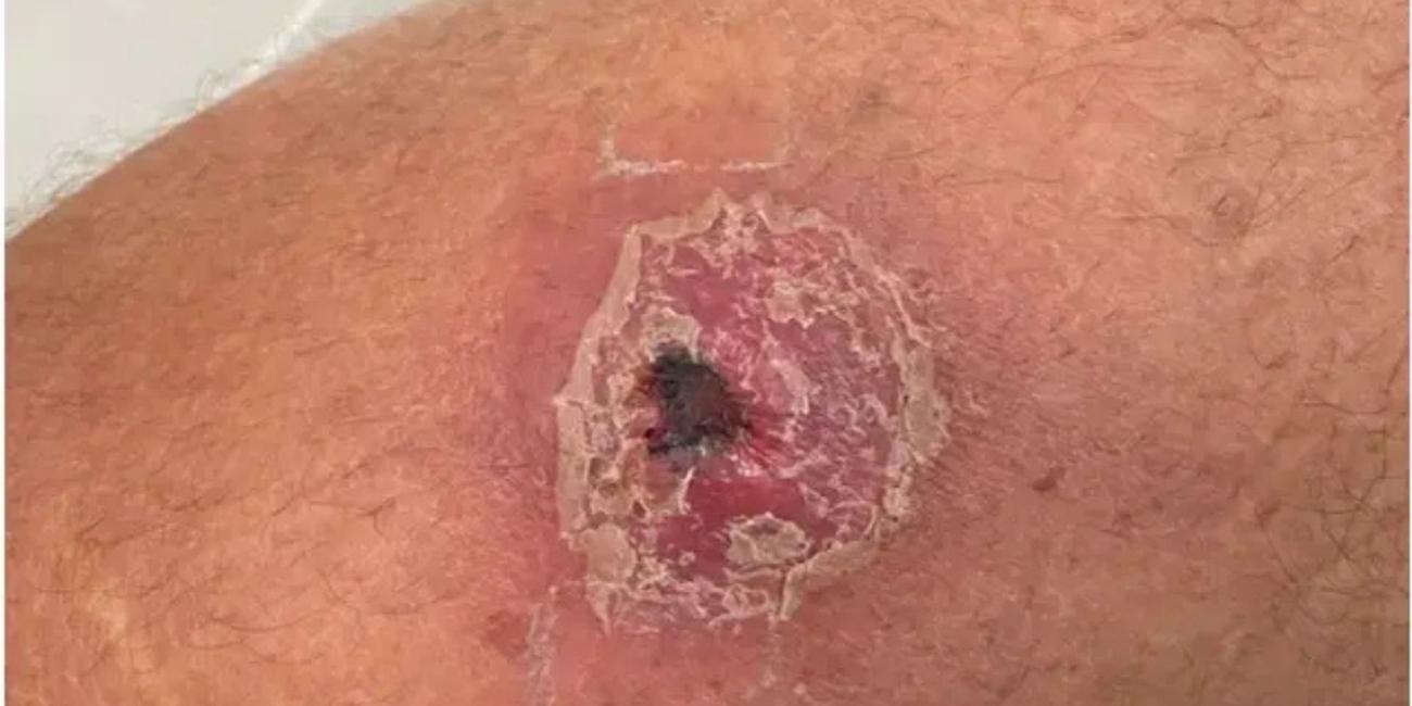 Suspected Buruli Ulcer Kills Eight People in Adamawa