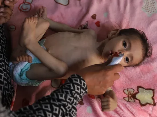 UNICEF Urges Full Access for Aid as Gaza Children Suffer from Severe Malnutrition
